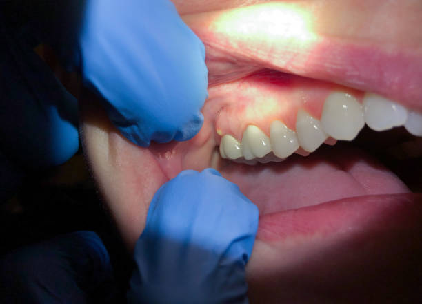 Best Root Canal Emergency Dentist  in St Paul, TX